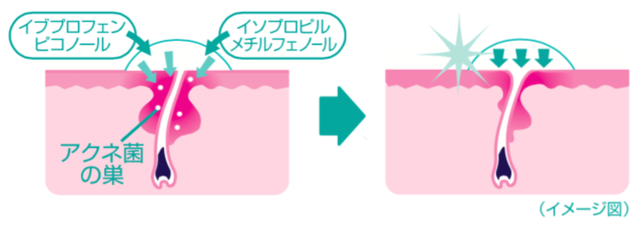 ニキビの根元まで届く高浸透クリームが、繰り返しがちな大人ニキビを根本から治します。